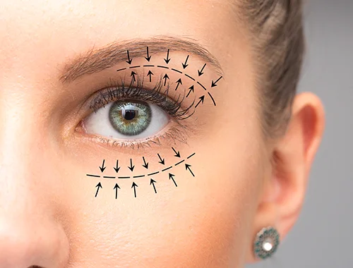 BLEFAROPLASTIA-1-1