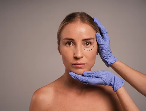 BLEFAROPLASTIA-3