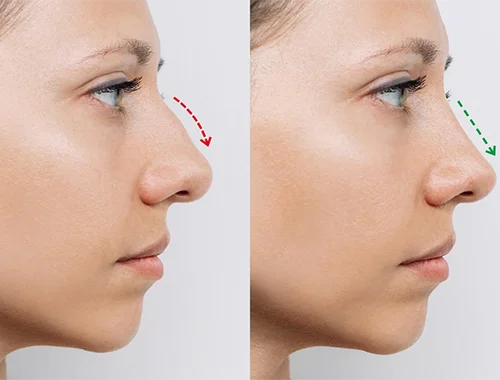 rinoplastia_005