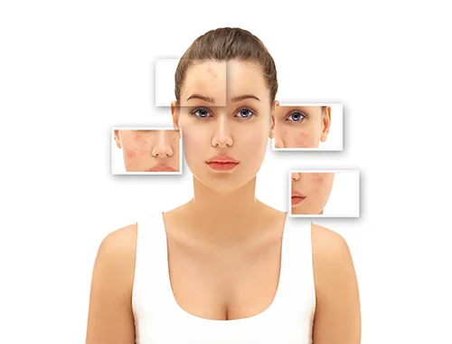 rosacea-1
