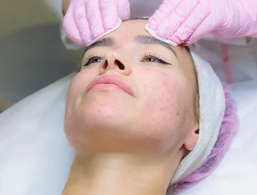 rosacea-2