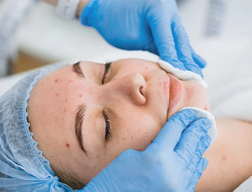 rosacea-3